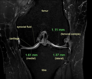 Resonancia magnética de rodilla al inicio del estudio